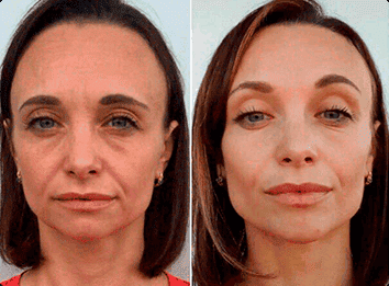 Prima e dopo Elesse Cream su rughe naso-labiali